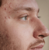 Best Acne Spot Treatment for Pimples - TMGskin.com