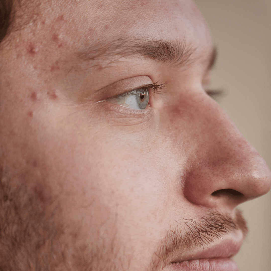 Best Acne Spot Treatment for Pimples - TMGskin.com