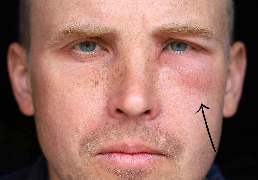 Can Stress Cause Facial Swelling? Exploring the Impact of Stress on Your Face - TMGskin.com