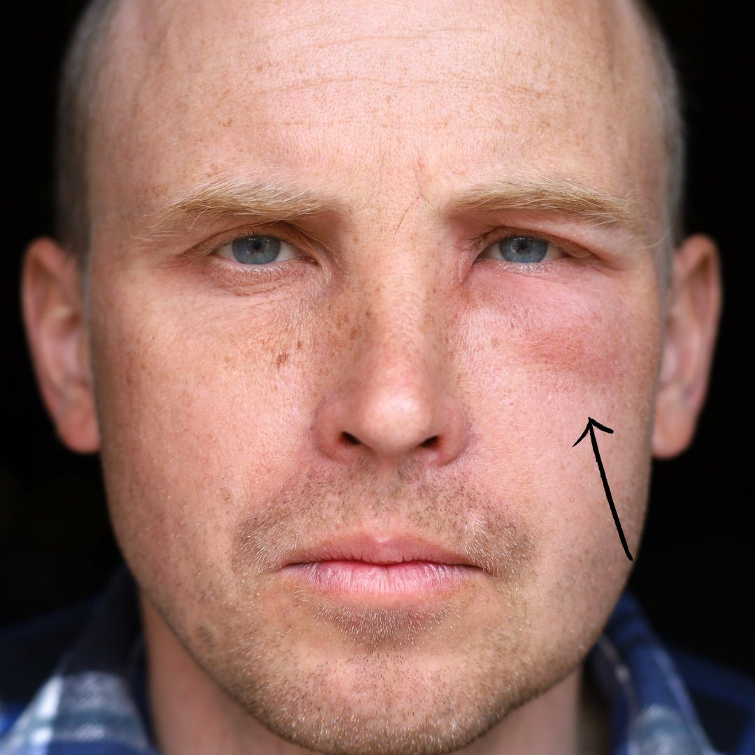 Can Stress Cause Facial Swelling? Exploring the Impact of Stress on Your Face - TMGskin.com