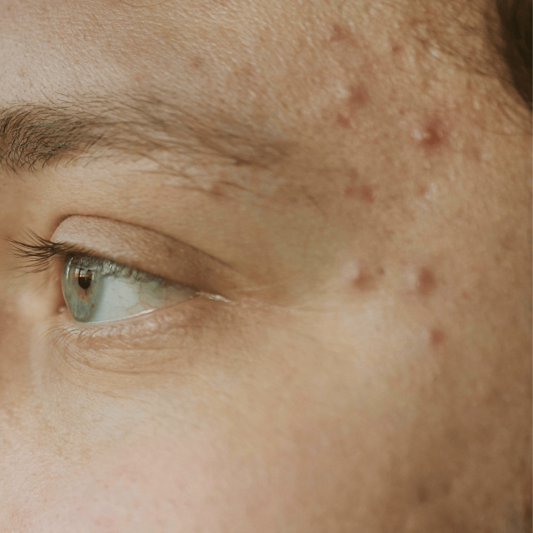 Effective Acne Treatment for Sensitive Skin - TMGskin.com