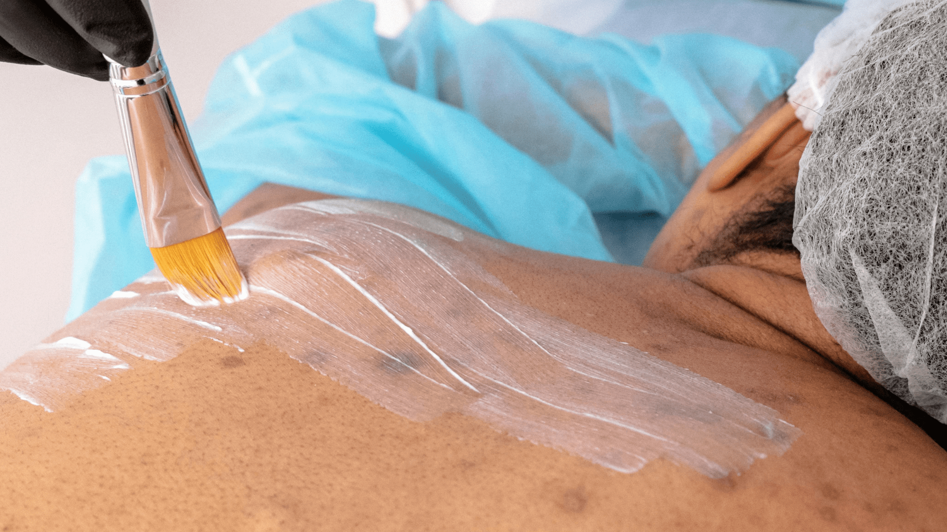 Effective Treatments for Acne on Shoulders and Back - TMGskin.com