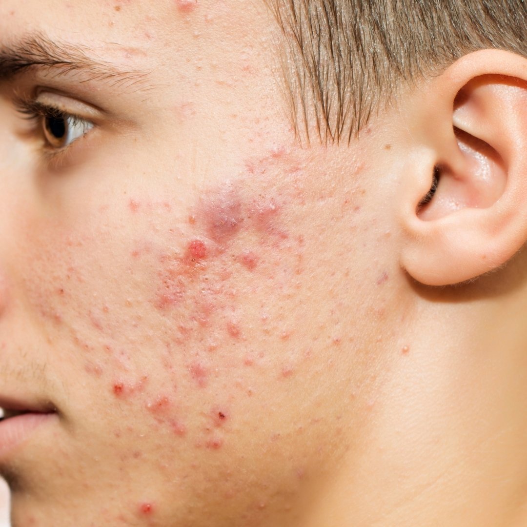 The Truth About Men’s Acne - TMGskin.com