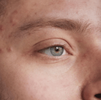 Understanding and Managing Acne Flare Ups - TMGskin.com