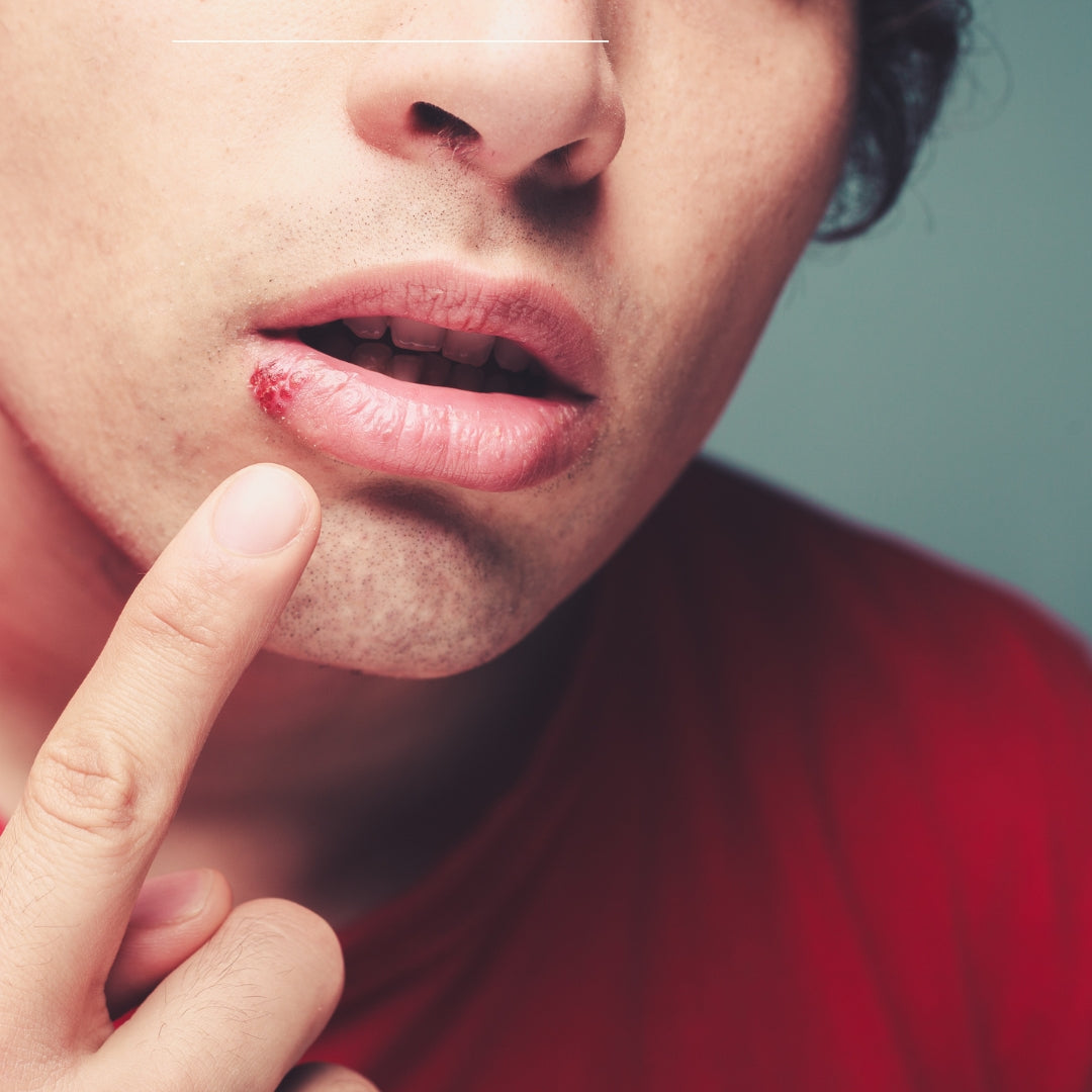 Can Stress Cause Cold Sores? Understanding the Link Between Stress and Fever Blisters