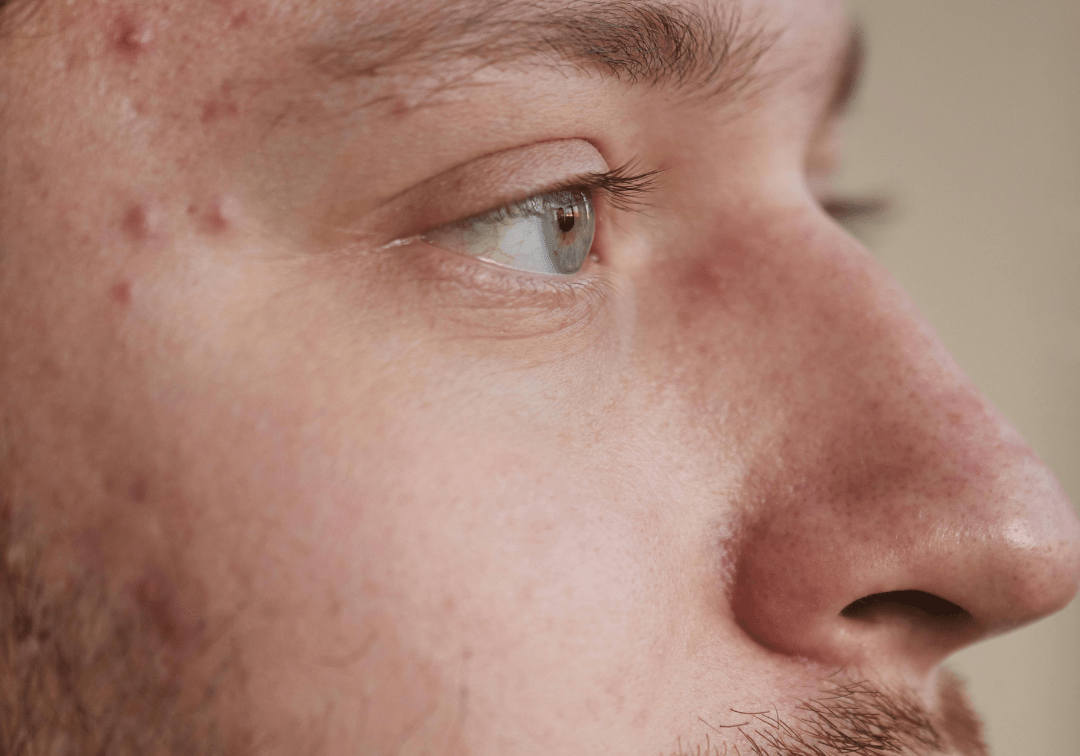 Best Acne Spot Treatment for Pimples - TMGskin.com