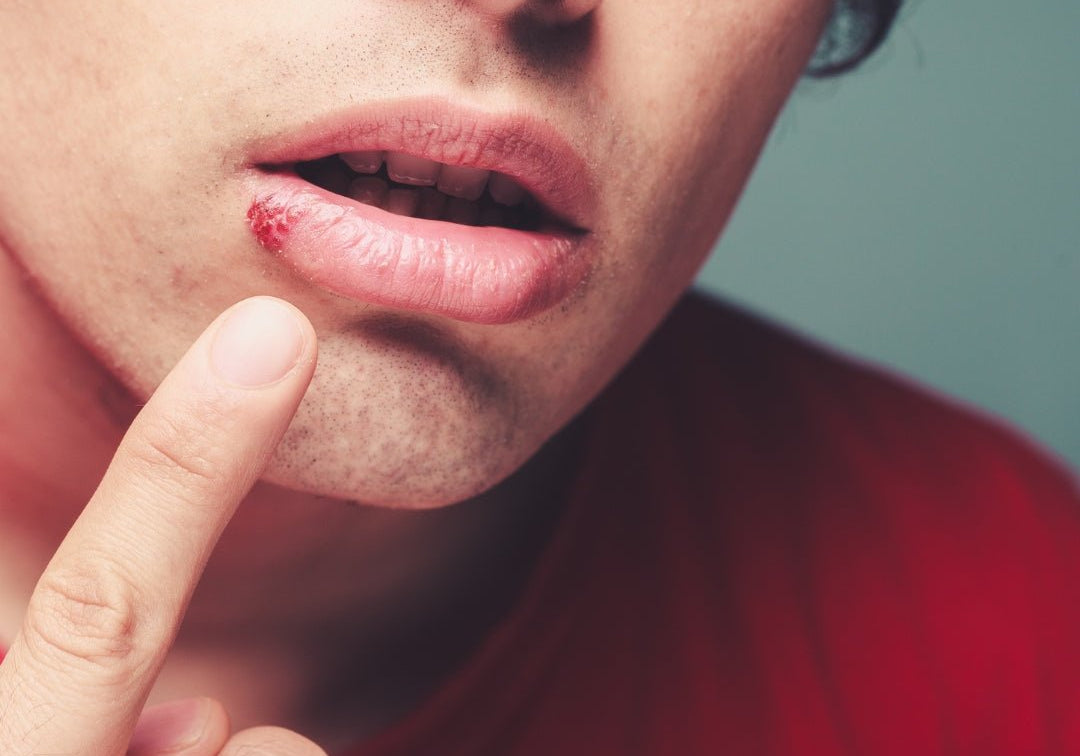 Can Stress Cause Cold Sores? Understanding the Link Between Stress and Fever Blisters - TMGskin.com