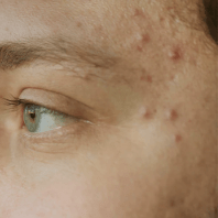 Effective Acne Treatment for Sensitive Skin - TMGskin.com