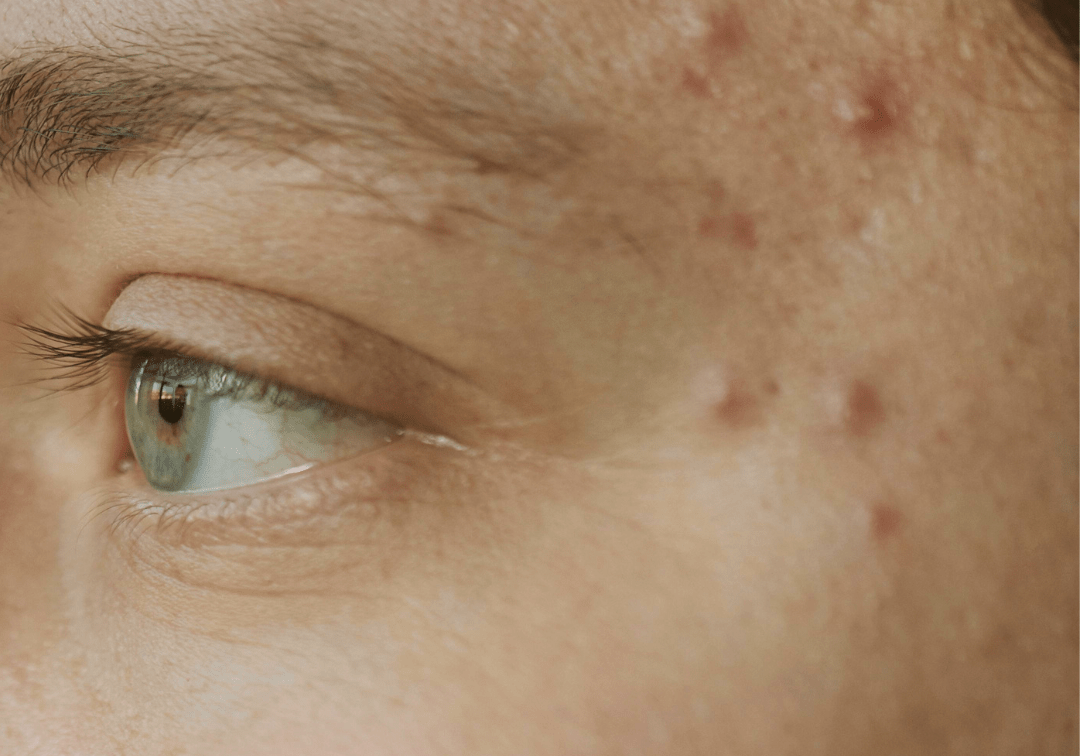 Effective Acne Treatment for Sensitive Skin - TMGskin.com