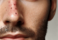 Effective Methods for Blackhead Extraction on the Nose - TMGskin.com