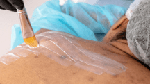 Effective Treatments for Acne on Shoulders and Back - TMGskin.com