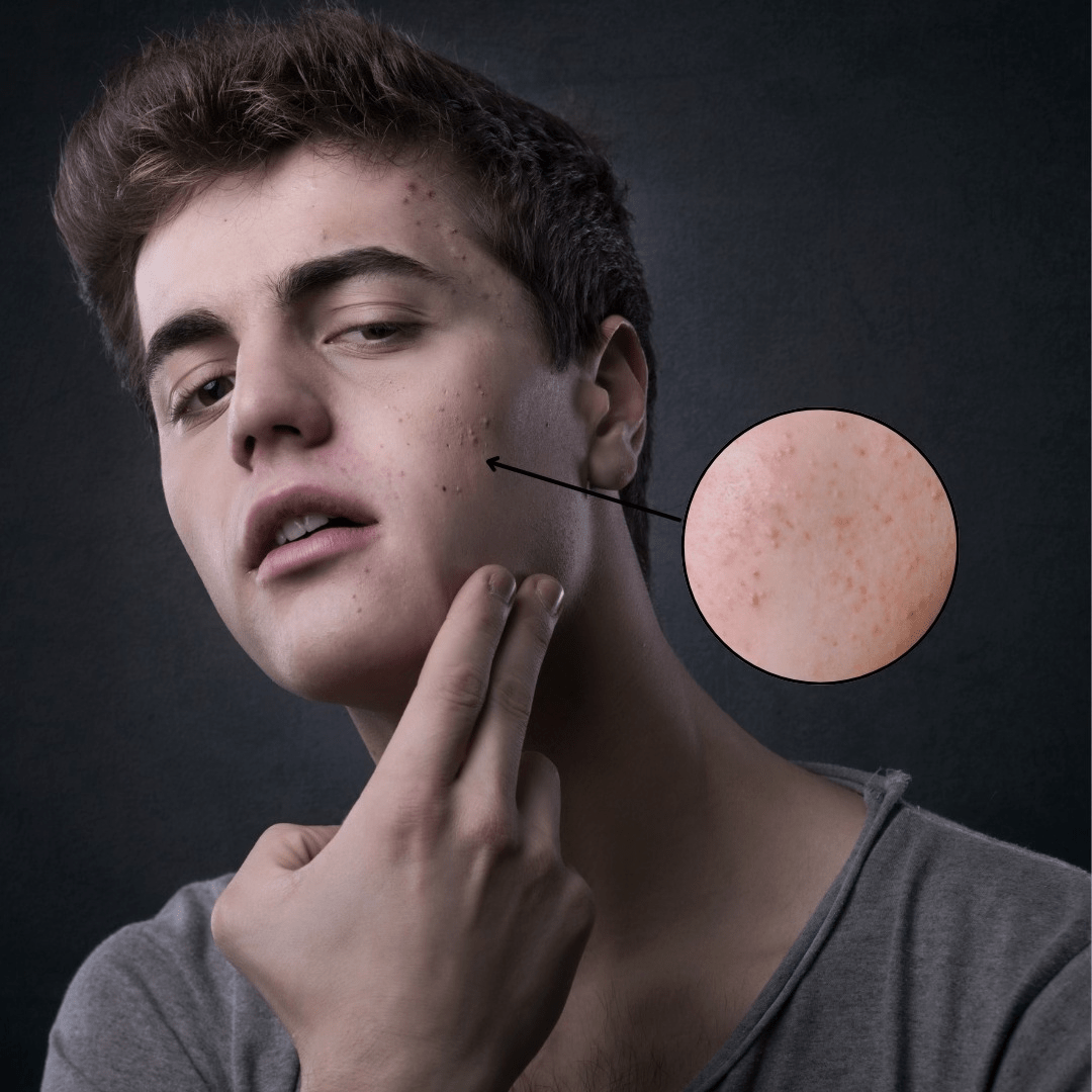 How to Find the Best Acne Spot Treatment for You - TMGskin.com