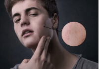 How to Find the Best Acne Spot Treatment for You - TMGskin.com