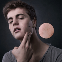 How to Find the Best Acne Spot Treatment for You - TMGskin.com