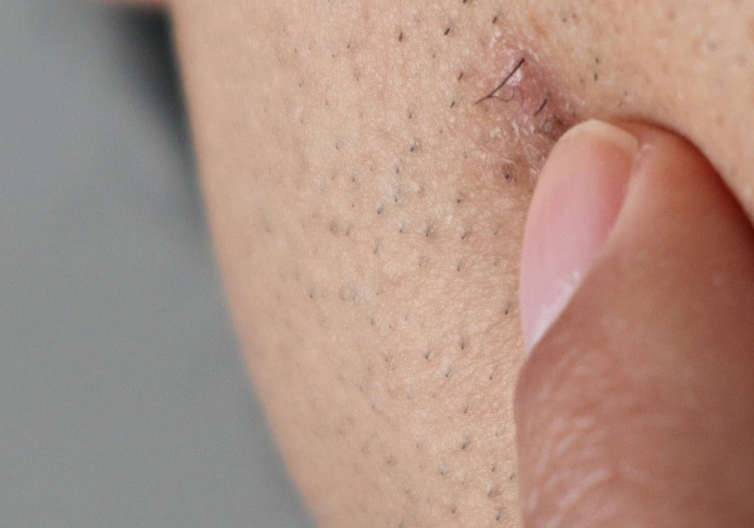 How to Prevent Ingrown Hairs - TMGskin.com