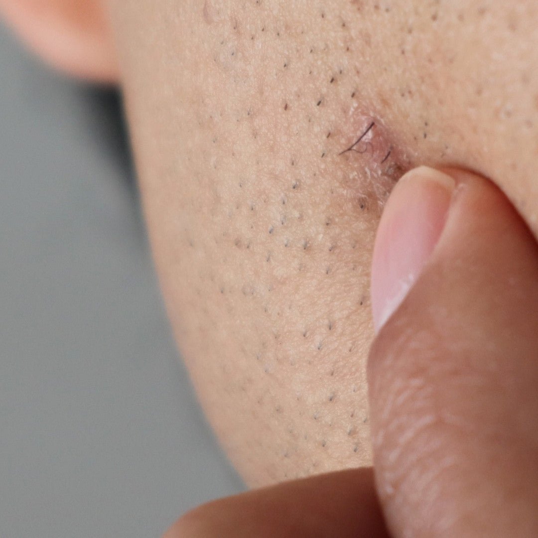 How to Prevent Ingrown Hairs - TMGskin.com
