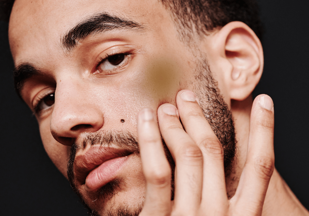 Melasma vs. Hyperpigmentation: Understanding the Key Differences - TMGskin.com