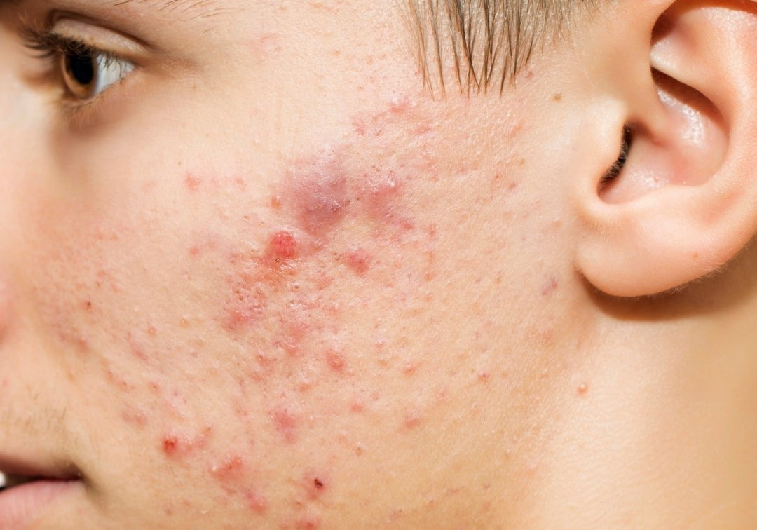 The Truth About Men’s Acne - TMGskin.com