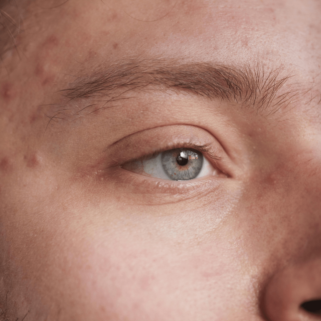 Understanding and Managing Acne Flare Ups - TMGskin.com