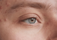 Understanding and Managing Acne Flare Ups - TMGskin.com