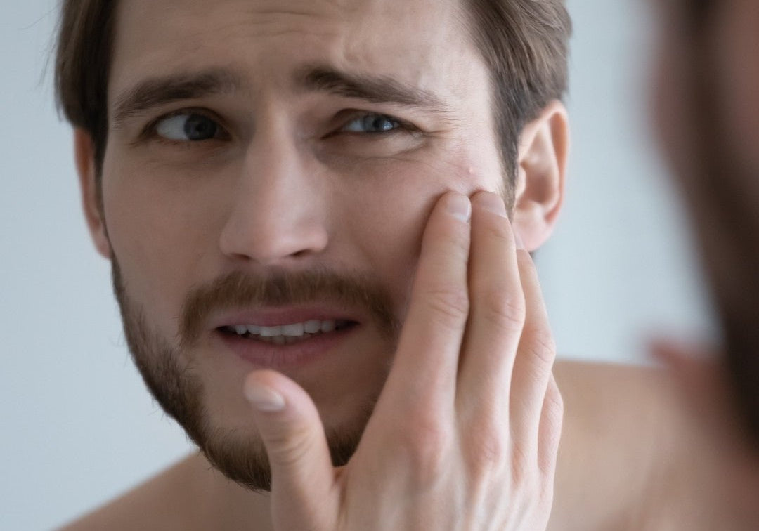 Why Your Skin Breaks Out Suddenly - TMGskin.com
